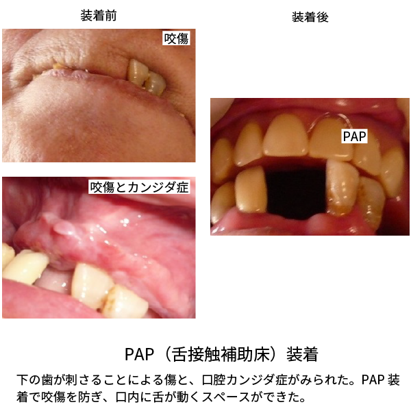 口腔粘膜剥離 | 剥離上皮膜と痂皮の違い 口腔外科 – ZQCO