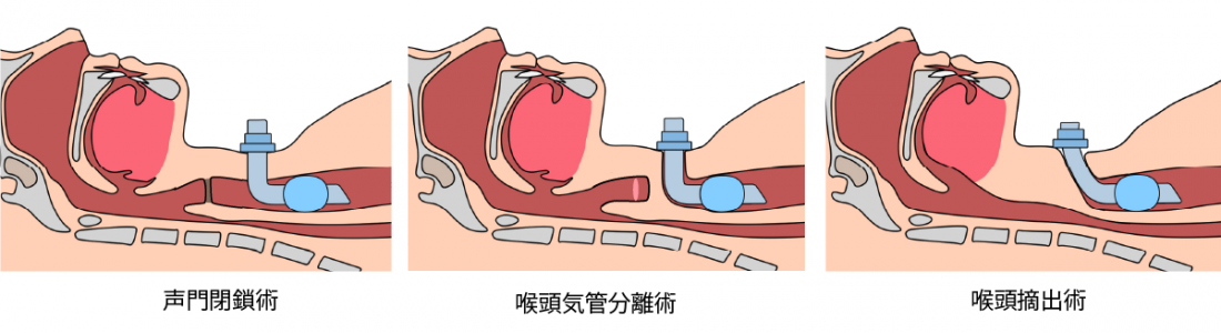 誤嚥防止術