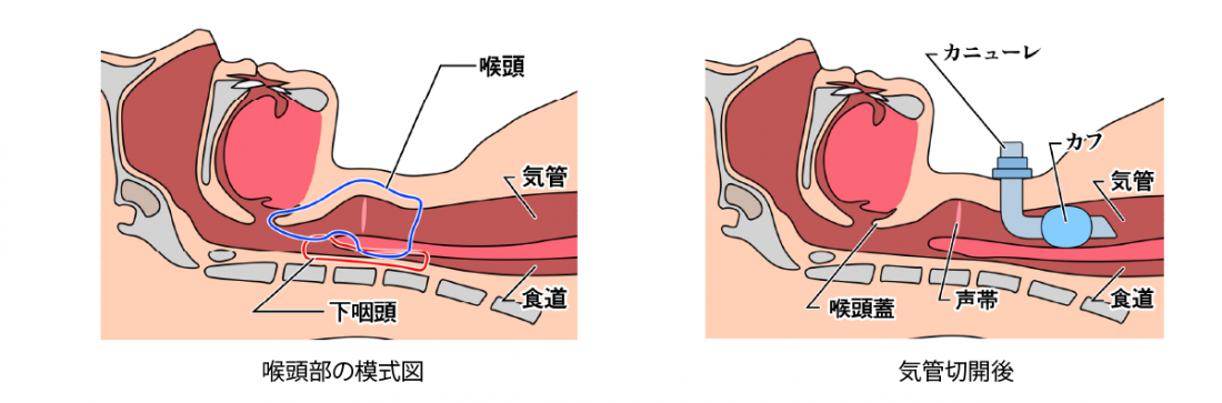 気管切開術