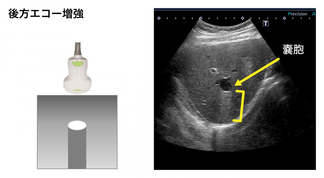 後方エコー増強