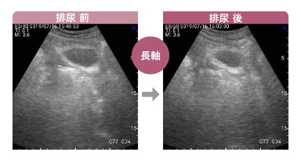 排尿前後を比較した画像2