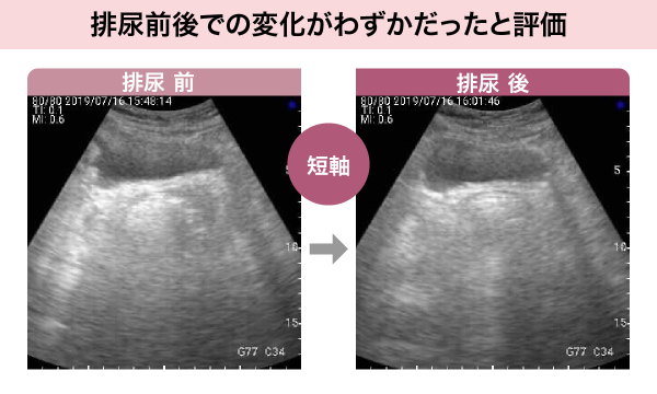 排尿前後を比較した画像1