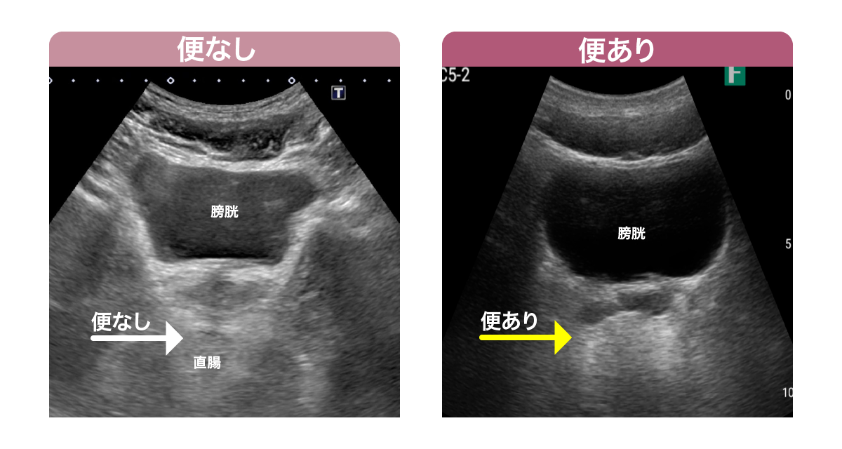 経腹アプローチ走査法