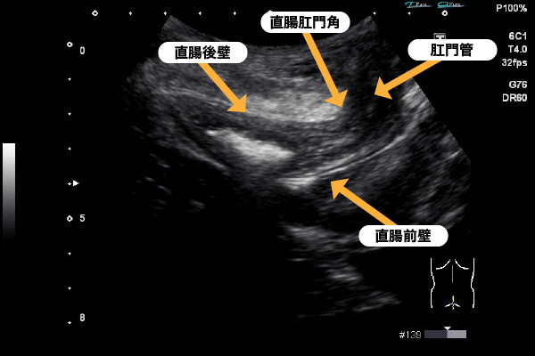 直腸の見え方