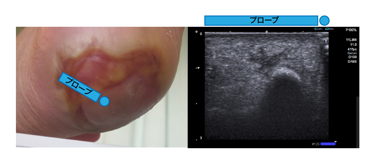 踵部の褥瘡DTI疑い