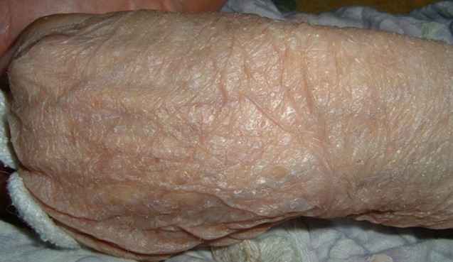高齢者の皮膚