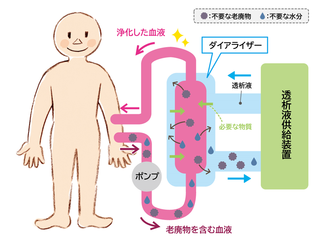 血液透析のしくみ