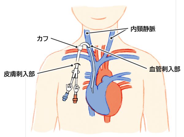 カフ型カテーテル(長期留置カテーテル)