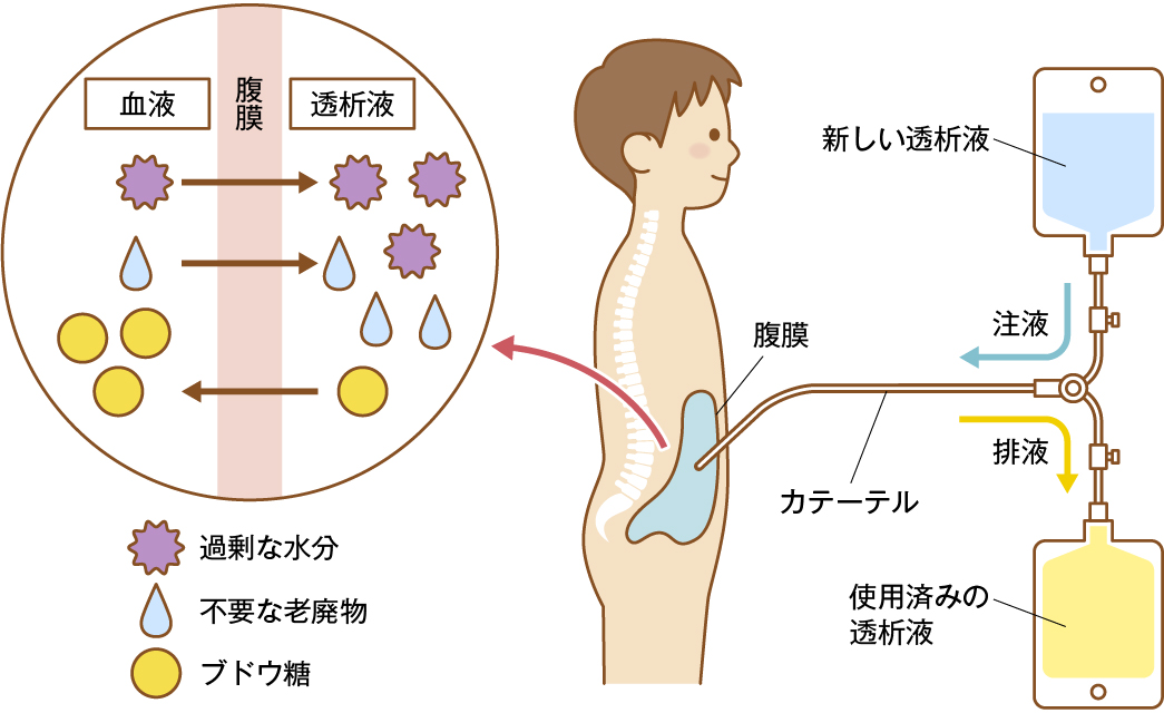 PDのしくみ