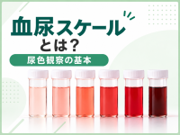 血尿スケールとは？尿色観察の基本